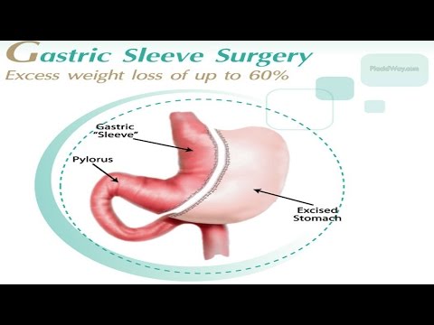 Best Gastric Sleeve in Mexico
